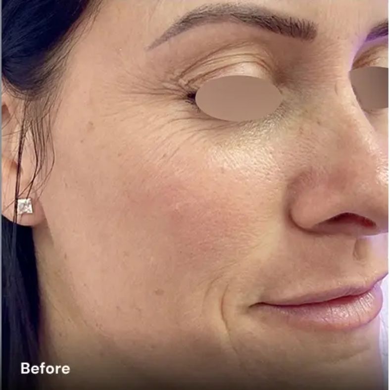 Avant après rajeunissement de la peau avec plateforme laser esthétique Vydence