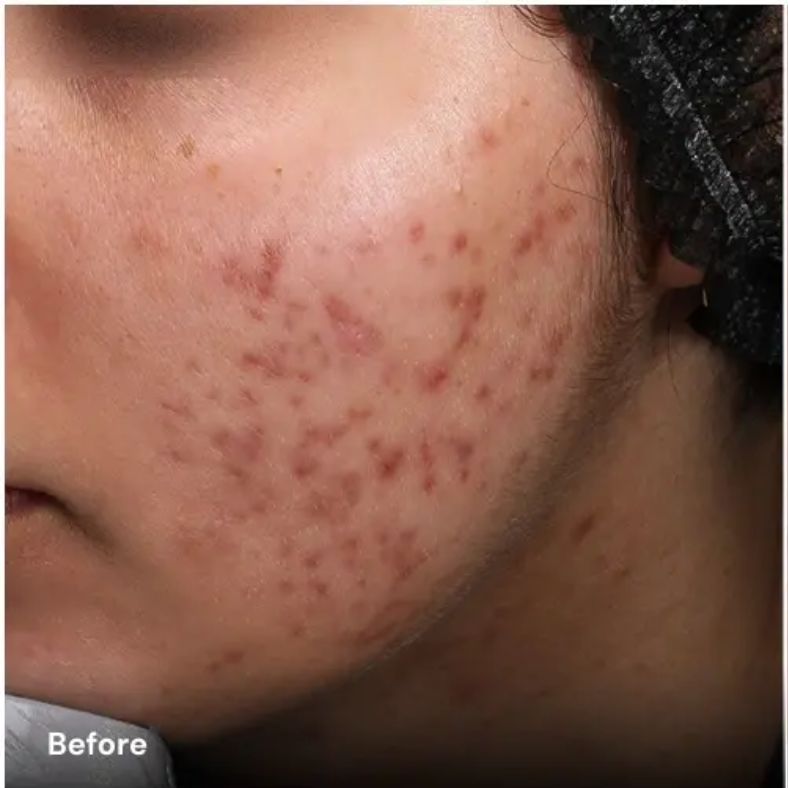 Avant après traitement de l’acné avec plateforme laser esthétique Vydence