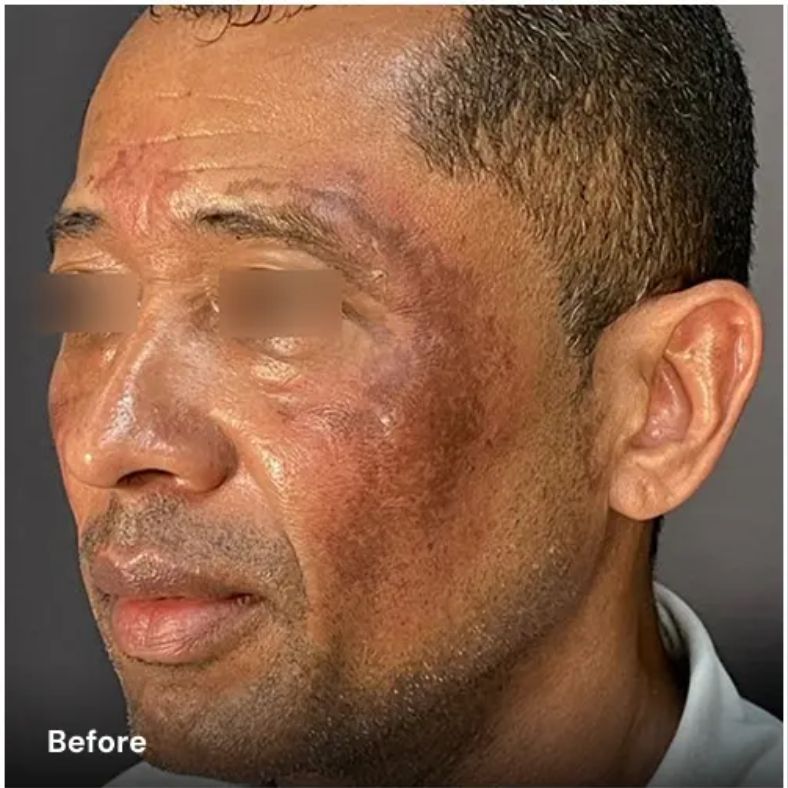 Avant après traitement du melasma avec plateforme laser esthétique Vydence