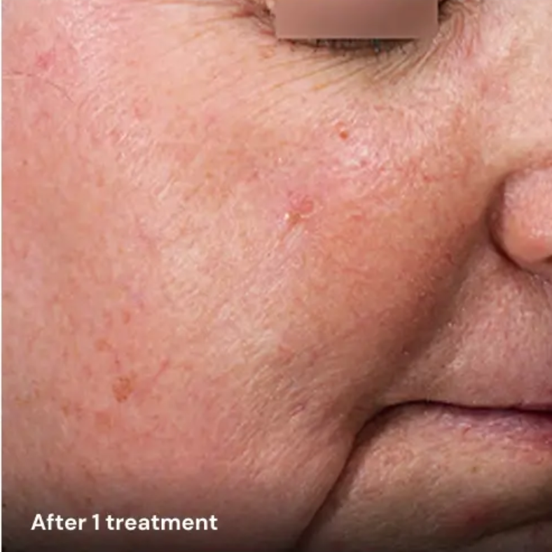 après couperose avec plateforme laser esthétique Vydence