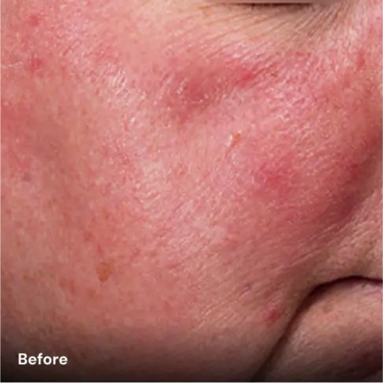 Avant couperose avec plateforme laser esthétique Vydence