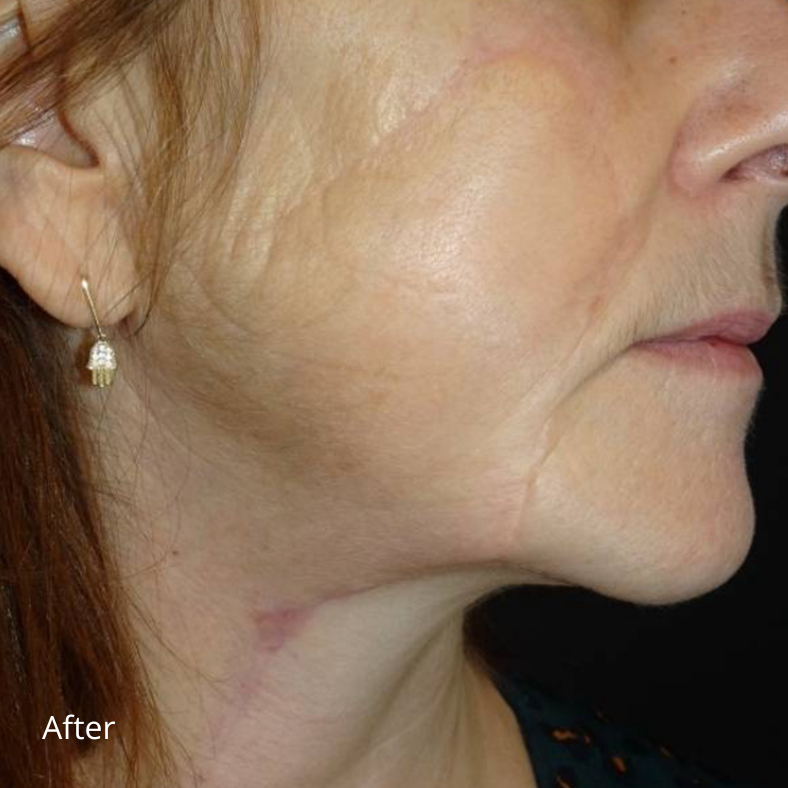 après cicatrice avec plateforme laser esthétique Vydence