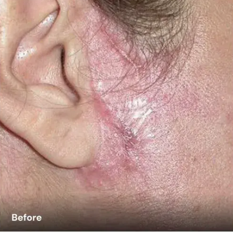 Avant traitement cicatrice avec plateforme laser esthétique Vydence