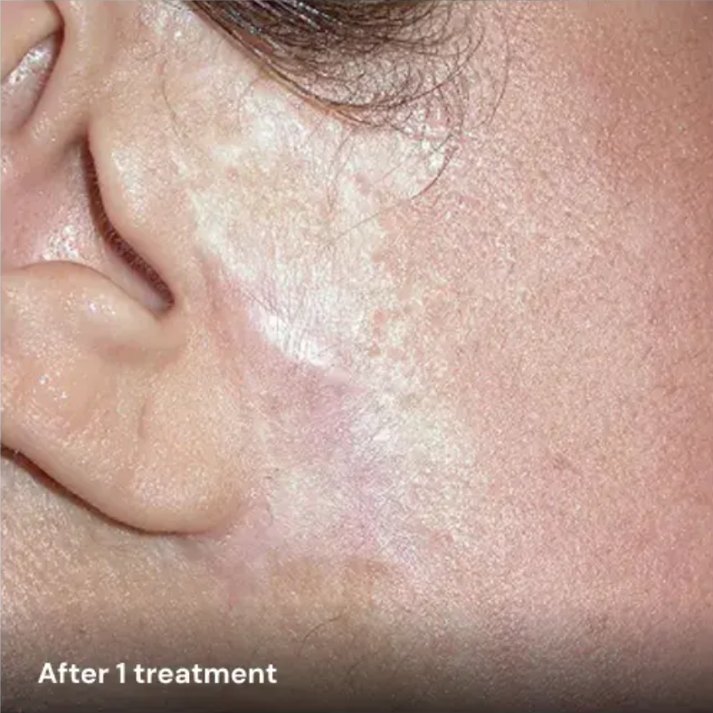 Après traitement cicatrice avec plateforme laser esthétique Vydence