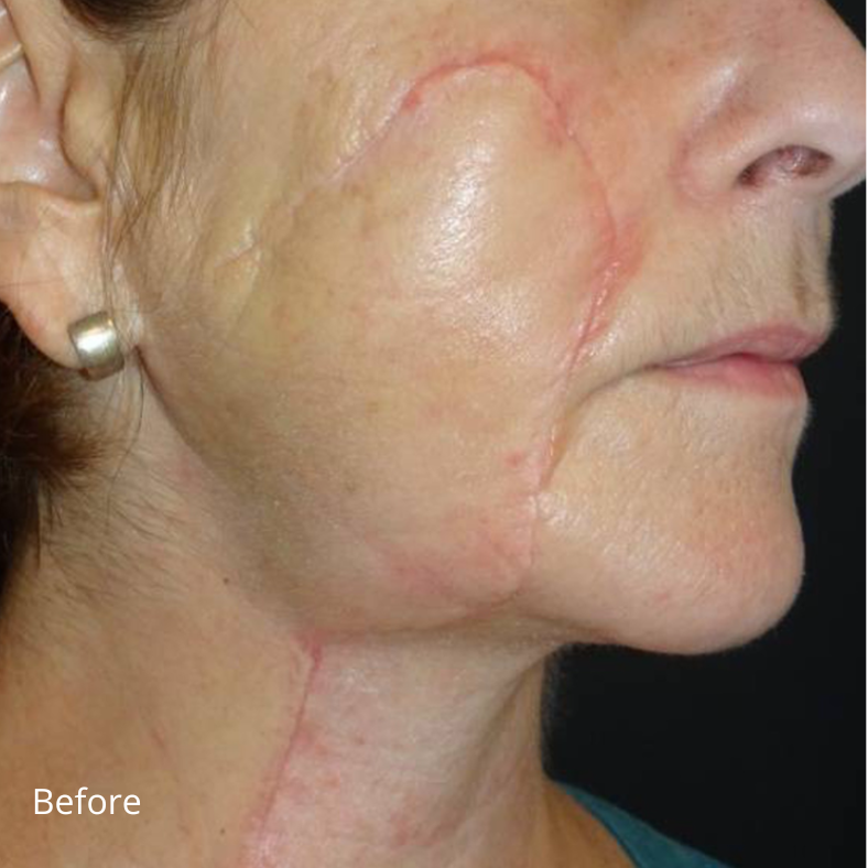 avant cicatrice avec plateforme laser esthétique Vydence